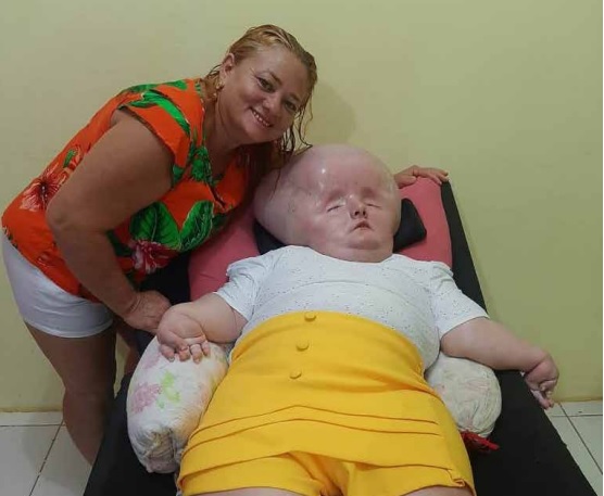 Mãe de jovem com hidrocefalia busca arrecadação para reforma da casa -  Jornal Pequeno