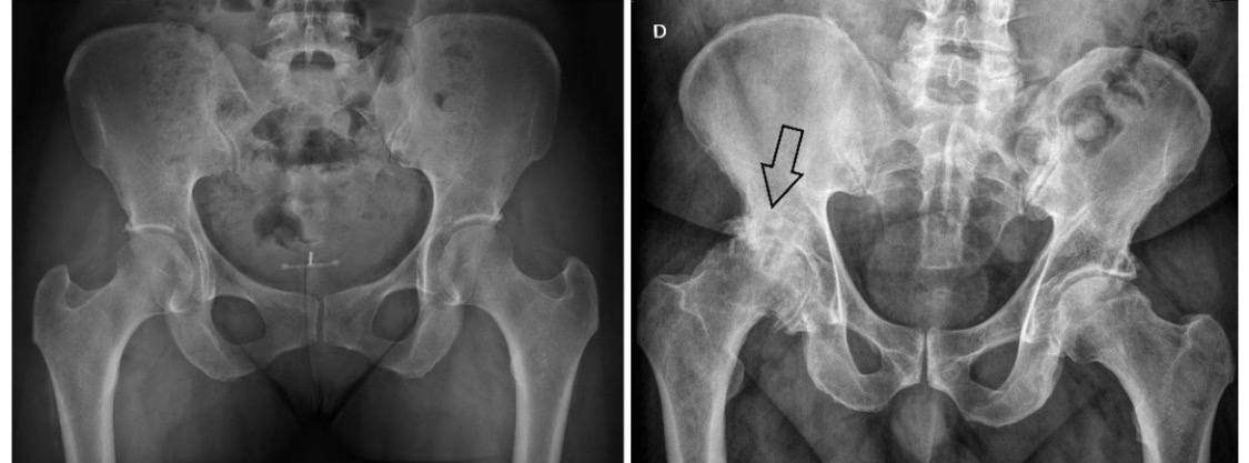 Artrose no quadril: esperar demais pode comprometer o resultado da cirurgia?